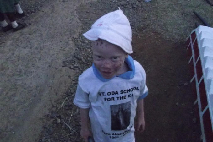 picture of Kenya Orphan Child with Albinism and Visual Impairment