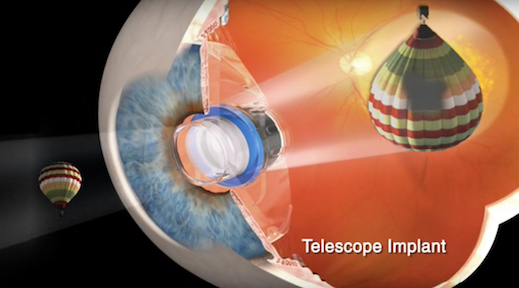 picture of Eye Telescope for macular Degeneration